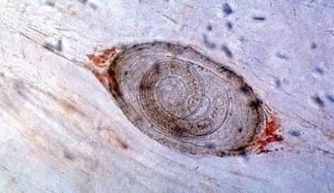 Trichinella
